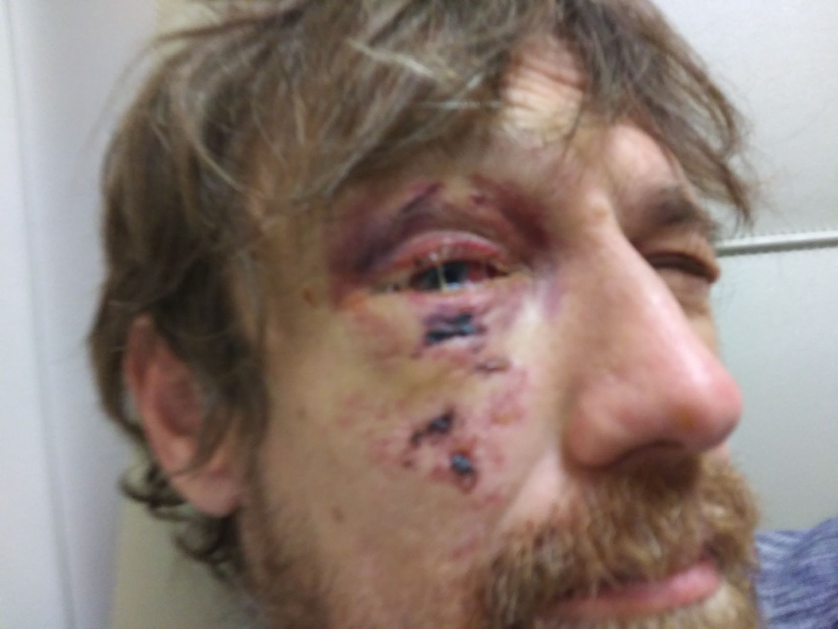 Daniel Gibson's eye after he was shot by a Defender pepper gun in the face